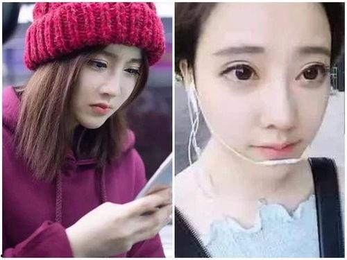 网红整形后鼻子照片对比,揭秘美丽蜕变之路